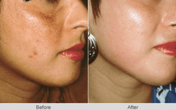 Fade the Past, Glow in the Present: Pigmentation Treatment at Its Best