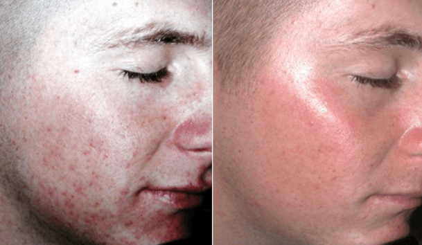 From Breakouts to Beauty, Banish Acne & Erase Scars