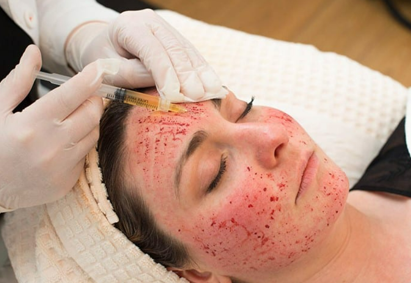 Screenshot 2025-04-05 203601 Vampire Facial Magic at Chiya Aesthetic Clinic