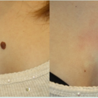 Mole, Tags, Corn, Warts Chiya Aesthetic Clinic