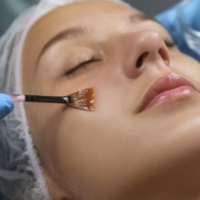 Peel 2 Chiya Aesthetic Clinic