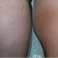 Stretch Marks Chiya Aesthetic Clinic